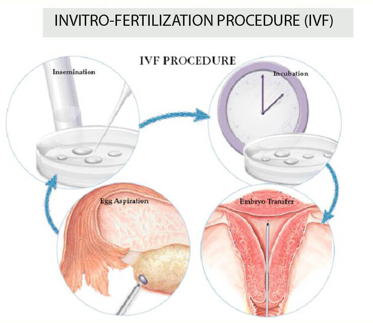 In Vitro Fertilisation IVF Procedure Treatment Seng Clinic